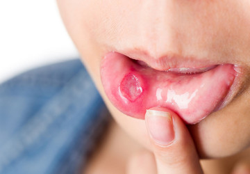 Những cách trị bệnh lở miệng THẦN KỲ không phải ai cũng biết