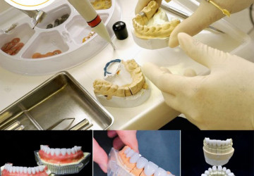 Làm răng sứ 4 cái | Chi phí và quy trình thực hiện như thế nào???