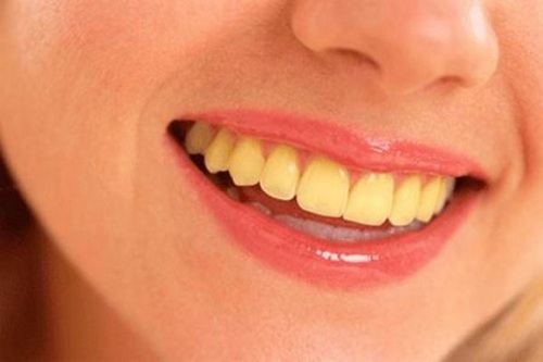 Tại sao răng có màu vàng