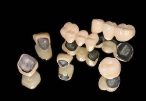 răng sứ titan sử dụng được bao lâu