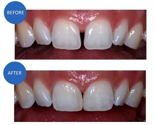 răng thưa và cách khắc phục