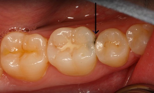 Sâu chân răng 2