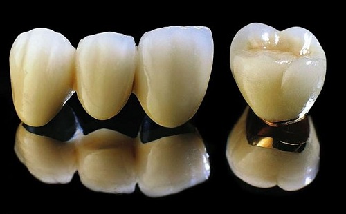 Cách nhận biết răng sứ titan