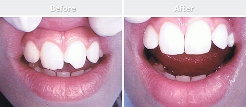 Nguyên nhân bị mẻ răng 2