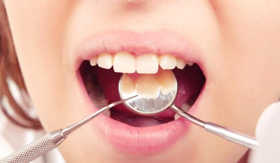 Điều trị viêm tủy răng hồi phục
