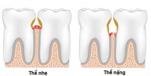 Thói quen xỉa răng ảnh hưởng ra sao tới sức khỏe răng miệng