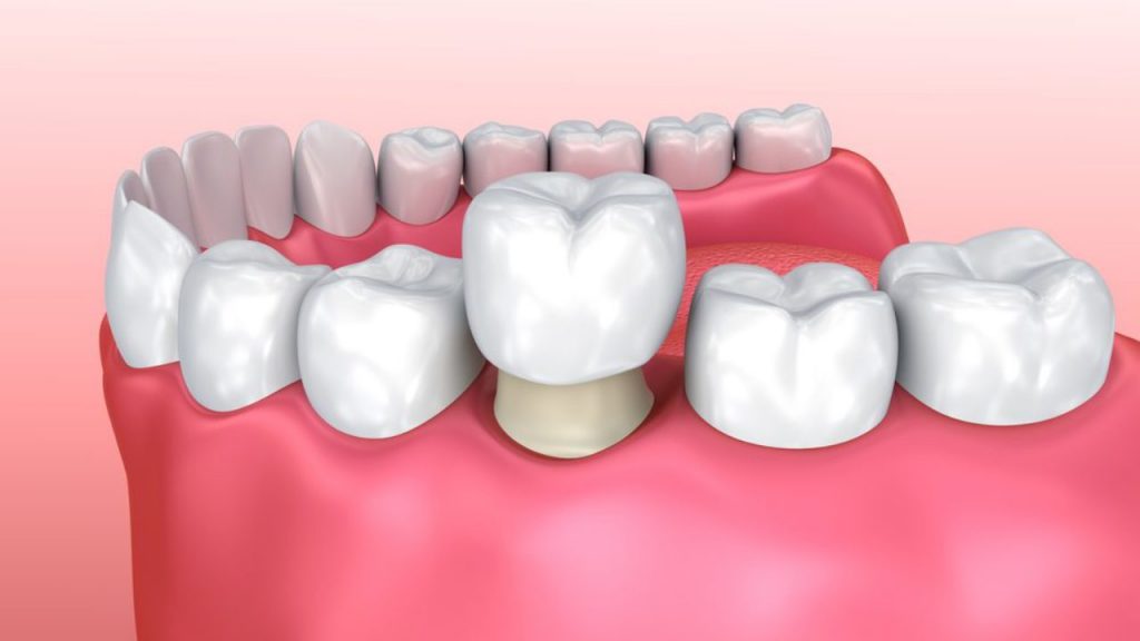 Làm răng sứ cho răng hàm 