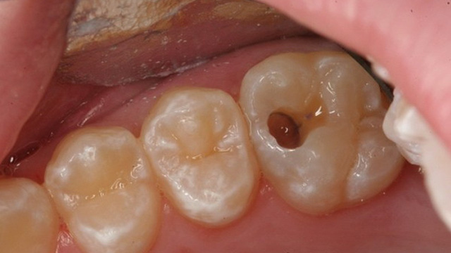 Làm răng sứ cho răng hàm 