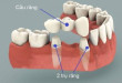 Làm răng sứ cho răng hàm – Ưu điểm, cách thực hiện, loại nào tốt?