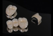 “New” chính xác về độ bền của răng sứ cercon?”