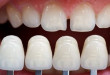 Những tầm quan trọng có nên bọc răng sứ không? Xem ngay<<<