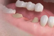Làm cầu răng có đau không ?