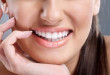 Bọc mão răng sứ – Giải pháp toàn diện cho hàm răng trắng sáng như SAO