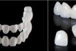 Phân loại răng sứ- Giải pháp sở hữu hàm răng bền đẹp