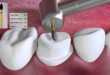 Bật mí bạn nên kiêng gì sau khi hàn răng?