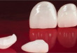 Răng sứ emax – Đặc điểm và những lưu ý khi sử dụng