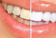 Tác dụng của phương pháp làm răng sứ thẩm mỹ
