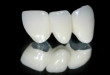 Bật mí cho bạn về độ bền của răng sứ titan