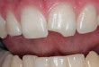 Nguyên nhân răng bị mẻ – Cách phòng ngừa cực tốt