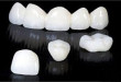 Những ưu điểm của răng sứ cercon mà bạn chưa biết