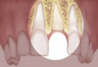 Lời giải đáp cho câu hỏi “vì sao nên ghép xương răng?”