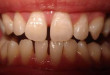 “HOT” phương pháp làm lại răng cửa hiệu quả nhất trên thế giới
