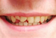 Top những nguyên nhân bị mẻ răng bạn không nên bỏ qua