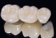 Sự thật thì răng sứ Cercon sử dụng được bao lâu sau khi bọc sứ?