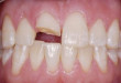 Tất tần tật các cách khắc phục răng bị mẻ được đánh giá cao nhất