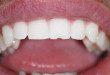 Làm gì khi bị mẻ răng? >>> Giải pháp cho răng bị mẻ