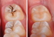 Có nên trám răng sâu không? Trám răng có ảnh hưởng gì không?