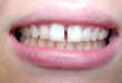 Làm răng sứ hay niềng răng khi răng thưa? <<< Xem ngay để biết