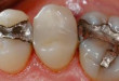 Quy trình hàn trám răng thẩm mỹ CHUẨN tại nha khoa