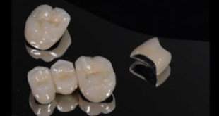 Răng sứ kim loại trong phục hình răng thẩm mỹ: Có nên không?