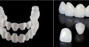 Phân loại răng sứ- Giải pháp sở hữu hàm răng bền đẹp