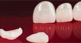 Răng sứ emax – Đặc điểm và những lưu ý khi sử dụng