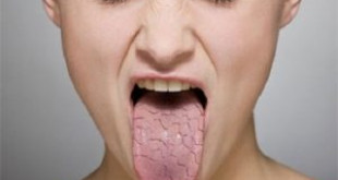 Cách điều trị bệnh khô miệng rát lưỡi hiệu quả nhất