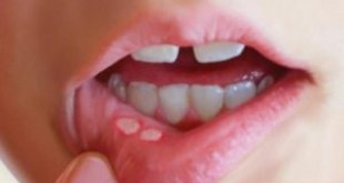 Lở miệng bao lâu thì khỏi phụ thuộc vào cách bạn chăm sóc răng miệng