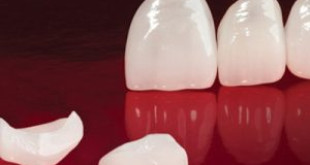 Hot răng sứ cercon có tốt không>>> Giải đáp từ chuyên gia