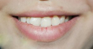Làm sao để khắc phục răng cửa mọc lệch hiệu quả nhất?