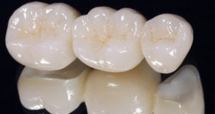Bọc răng sứ không kim loại có tốt không theo chuẩn Y khoa