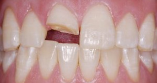 Cách phục hồi răng bị mẻ hiệu quả cho bạn hàm răng hoàn mỹ hơn