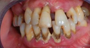 Giữa lại răng khôn gây ra những nguy hiểm gì?