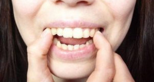 Răng hô có tính di truyền hay không?