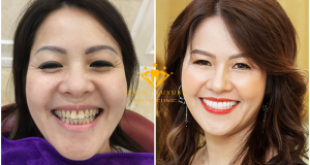 Làm răng sứ đẹp nhất Hà Nội – Địa chỉ được nhiều người lựa chọn