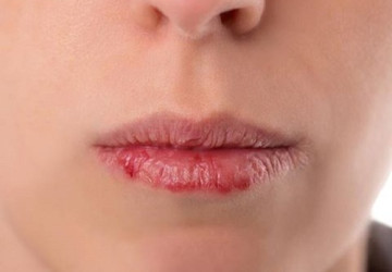 5 tuyệt chiêu chữa khô da quanh miệng bạn nên thử ngay
