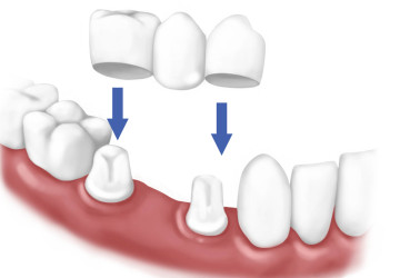 Làm cầu răng có thể dẫn đến hôi miệng không?