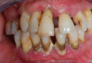 Giữa lại răng khôn gây ra những nguy hiểm gì?