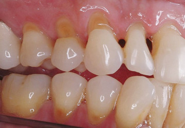 Những tác hại của tật nghiến răng
